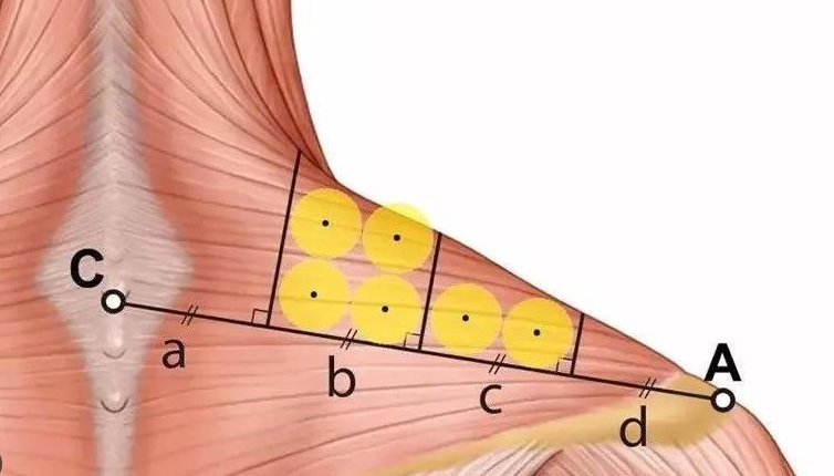 Trapezius Botulinum Toxin Type A 